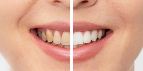 Before and After Teeth Whitening