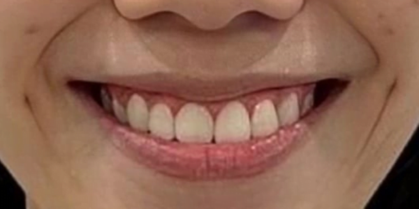 After Photo of Self Ligating Braces