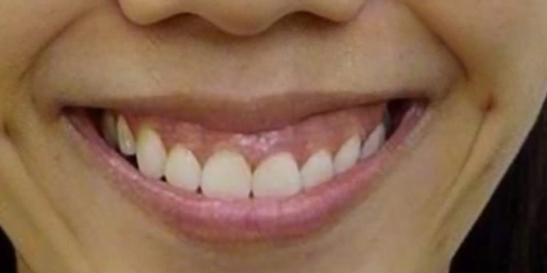 Before Photo of Self Ligating Braces