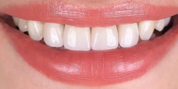 After Photo of Porcelain Crowns