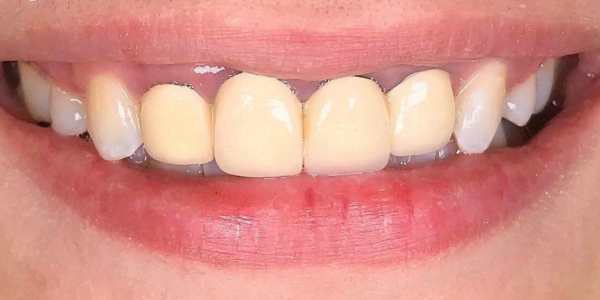 Before Photo of Porcelain Crowns