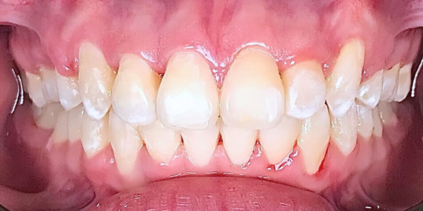 After Photo of Self Ligating Braces