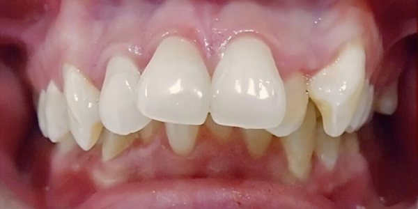 Before Photo of Self Ligating Braces