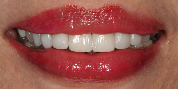 After photo of Full Mouth Rehabilitation