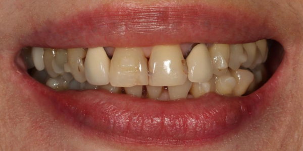 Before photo of Full Mouth Rehabilitation