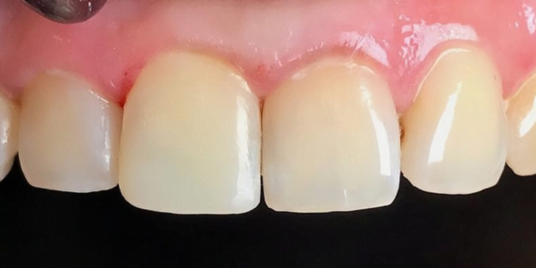 After Photo of Dental Filing