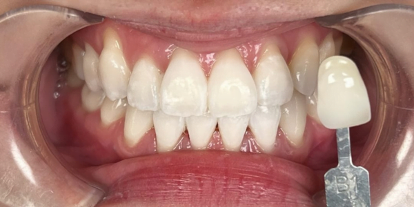 After Photo of Teeth Whitening