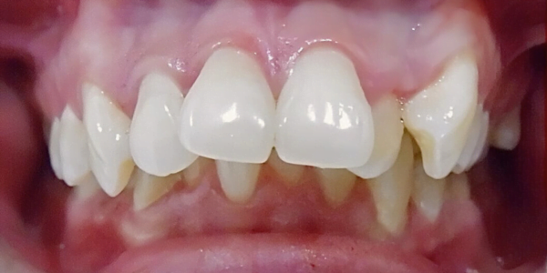 A photo showing Misaligned Teeth