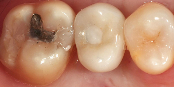 After photo of a dental implant